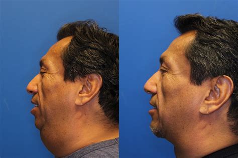 Necklift okanagan  Jacono performed a deep neck lift, removing and repositioning extra platysma muscle