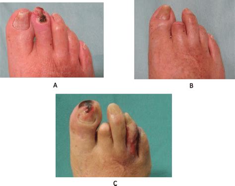 Necrotic foot icd 10 54 may differ