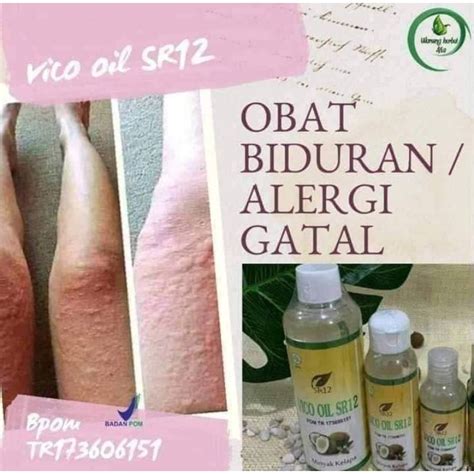 No togel gatal gatal Obat gatal alami yang pertama adalah menggunakan ‘terapi dingin’ ke area kulit yang mengalami gatal-gatal