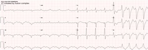 Nonsustained ventricular tachycardia icd-10 Search Results