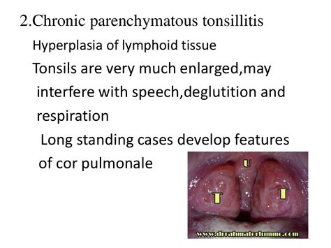 Notalgia paresthetica icd-10 1 contain annotation back-references that may be applicable to G57