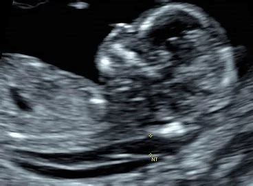 Nuchal translucency scan london  020 7725 0528 [email protected] Wimpole Street, London Opening Times