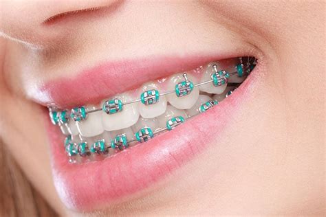 Orthodontics greystanes You will see for yourself that the orthodontist offers effective and affordable braces in the Lehigh Valley, PA area and surrounding towns of Macungie PA 18062, Orefield PA 18069, Easton PA 18045, Freemansburg PA 18017, Northampton PA 18067, Nazareth PA 18064, Breinigsville PA 18031, and Center Valley PA 18034