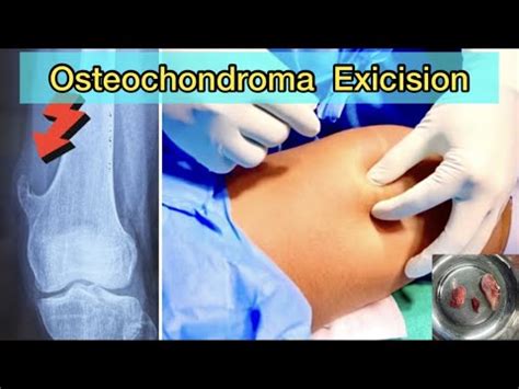 Osteochondroma excision cpt The cause is not certain