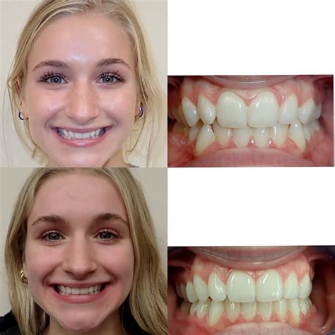 Ozark invisalign teen From the makers of Invisalign® aligners, Vivera™ retainers are clear retainers for teeth after teeth straightening treatment