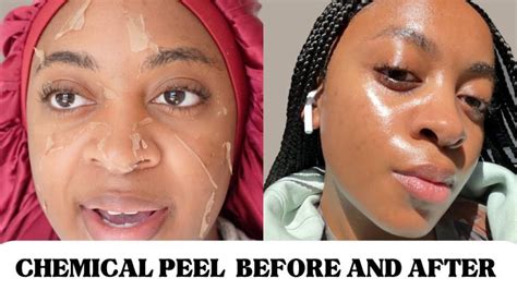 Pčak peilis  TCA peels can be used effectively to control brown spots and superficial seborrheic keratoses on your face and other area