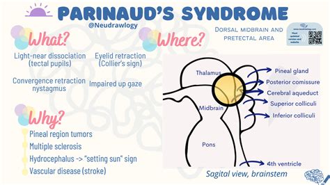 Parinaud syndrome sunset sign Also known as the pretectal, or sylvian aqueduct syndromes, it is characterized by paralysis of upgaze to both saccades and pursuit