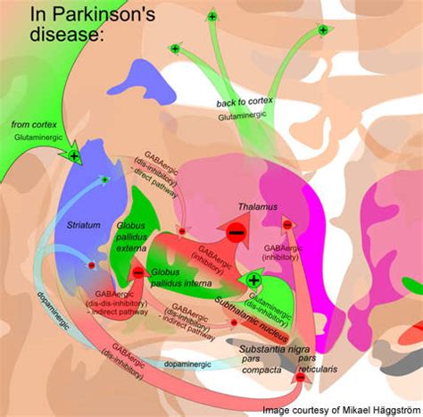 Parkinson's constipation miralax  In the United States, approximately 33 million adults have constipation, resulting in 2