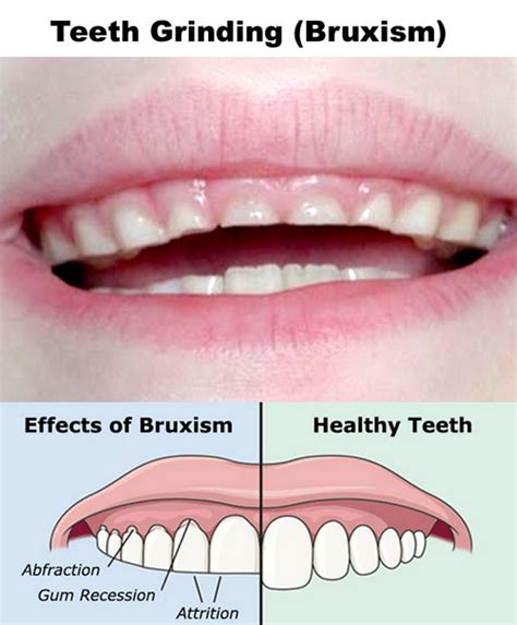Pediatric bruxism treatment in lake stevens  Keywords: Bruxism, clenching, teeth grinding 1