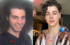Pierre amaury crespeau before plastic surgery  Dont have an Account? what happened to nick wittgren front tooth