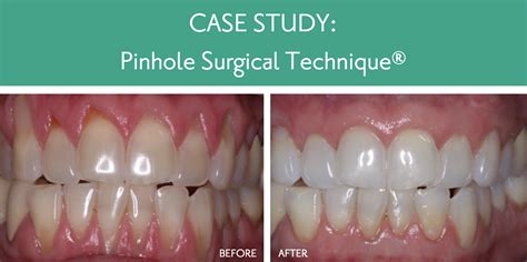 Pinhole gum surgery victoria  A full arch can be treated in just under an hour