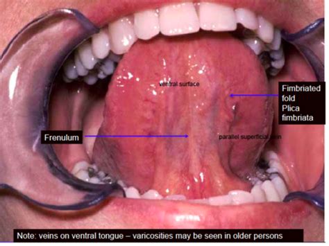 Plica fimbriata canker sore  Call your doctor if you start to notice any pain, redness, swelling, or oozing around your plica