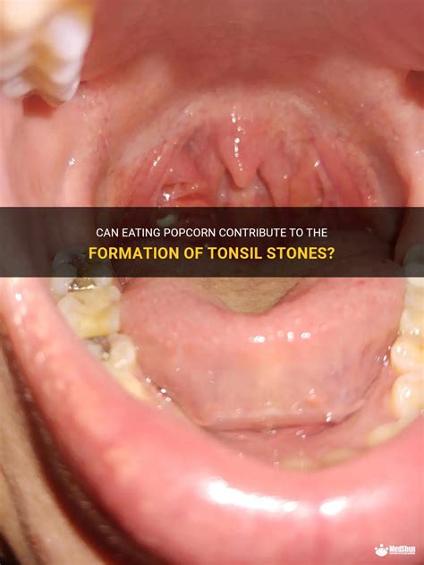 Popcorn shell stuck in tonsil  Start with a drink of water and see if that washes down the popcorn shell