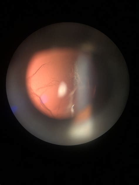 Posterior vitreous detachment icd 10 32 (non-billable); retinal breaks without detachment ICD-10 H33