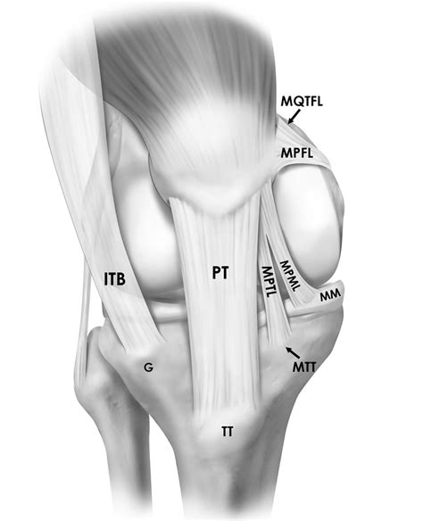 Potelah  These defects or injuries are typically graded on a scale from 1-4 to categorize the severity of the damage to the articular cartilage