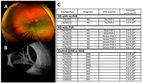Proliferative vitreoretinopathy icd 10 Operations were carried out within 24 h of first consultation in 174 (93