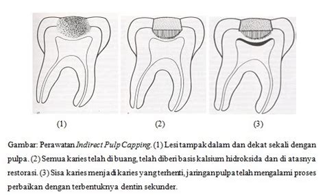 Pulpektomi adalah  Latar Belakang Investment material adalah material yang digunakan untuk menutupi