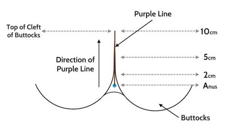 Purple line dilation accuracy 4% with a cervical dilatation of 3 cm to 84