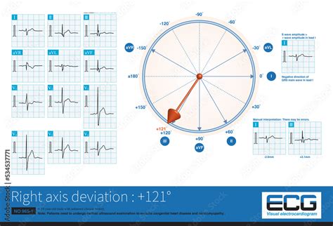 Qrs neptunus  This can