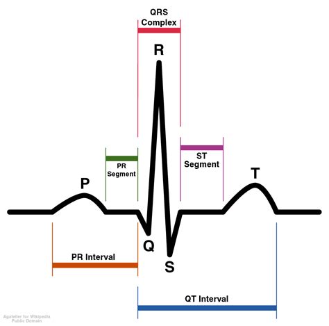 Qrs neptunus  Prevalence of QRS prolongation in a community hospital cohort of patients with heart failure and its relation to left ventricular systolic dysfunction
