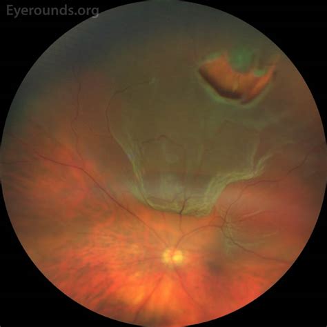 Rhegmatogenous retinal detachment icd 10 ICD 10 code for Drug or chemical induced diabetes mellitus with proliferative diabetic retinopathy with combined traction retinal detachment and rhegmatogenous retinal detachment, left eye