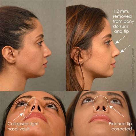 Rhinoplasty bucks county  The procedure has risks, such as bruising, swelling, bleeding under the skin, and possible damage to the eye