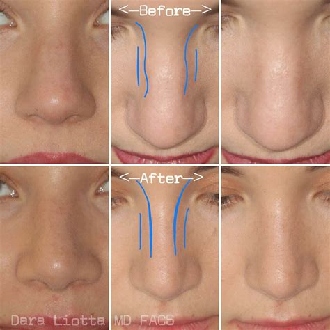 Rhinoplasty kelowna  During rhinoplasty, the underlying bone, cartilage, and tissues are sculpted to change the size and shape of the nose and/or to improve breathing, if needed