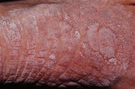 Scrotal lichen simplex chronicus LSC (circumscribed neurodermatitis) is characterized by a central lichenificated plaque thickened and often hyperpigmented, usually surrounded by lichenoid papules and, along the borders with