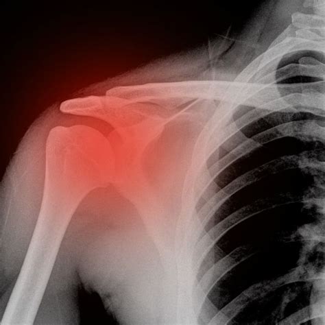 Shoulder fracture southlake  Still The Team to Trust for All of Your Orthopedic Needs 