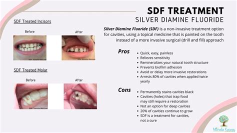 Silver diamine fluoride holistic Silver diamine fluoride combines the remineralizing effects of fluoride and the antibacterial effects of silver and thus provides an alternative care path for those patients in whom traditional