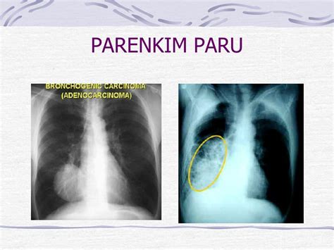 Sinus costophrenicus adalah  tentu yang sebaiknya dapat menjelaskan terkait kondisi anda saat ini adalah dokter yang merawat anda