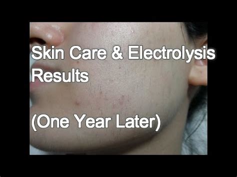 Skin rejuvenation snoqualmie  Skin resurfacing is a specific type of skin rejuvenation that involves removing layers of built-up skin cells and debris, accelerating your skin’s natural process of desquamation