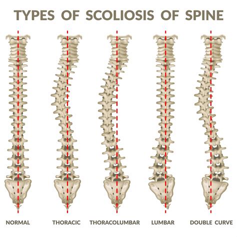 Skoliosis vertebra thorakalis  1