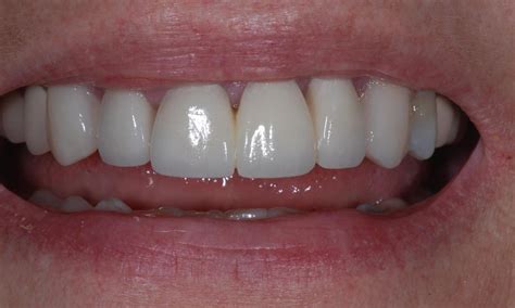 Smile rejuvenation odessa Smile Rejuvenation With Dental Implants