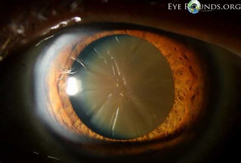 Snowflake cataract icd 10 213 [convert to ICD-9-CM] Cataract with neovascularization, bilateral