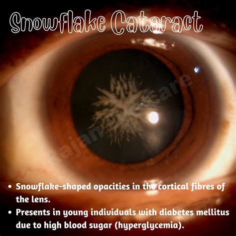 Snowflake cataract icd 10  R1