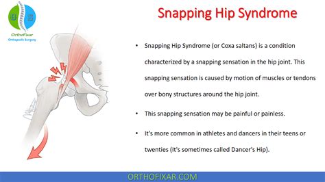 Southlake hip snapping  The prevalence of asymptomatic SH in the population
