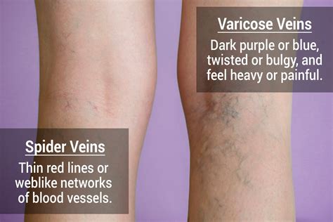 Spider vein treatment near me woodland park  He completed his undergraduate education at Muhlenberg College in Allentown PA; he obtained his Doctor of Medicine from the Medical College of Virginia in Richmond, Virginia, with post graduate training at St