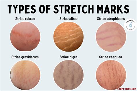 Stretch marks groin  Stretch marks can materialize on any fraction of the body—in a woman’s stomach when she is pregnant, in a body builder’s shoulders due to weightlifting—all this is brought about by the skin stretching