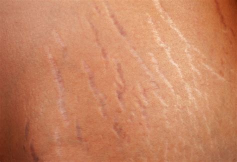 Stretch marks on groin Striae distensae (stretch marks) are linear atrophic plaques