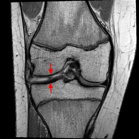 Symptomen meniscusproblemen  Knee injury causing hip pain can be a possibility in many