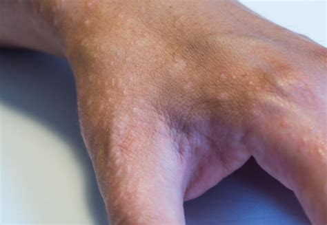 Tapioca bumps on hands <em> Some even claim that it freezes and</em>