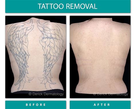 Tatto removal moncton  Best Color Fading Tattoo Removal Cream Inked Up Tattoo Removal