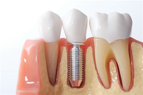 Teeth implants crowborough  You can also call 866-383-0748 and be connected with a dentist to speak about your options for low-cost dentures