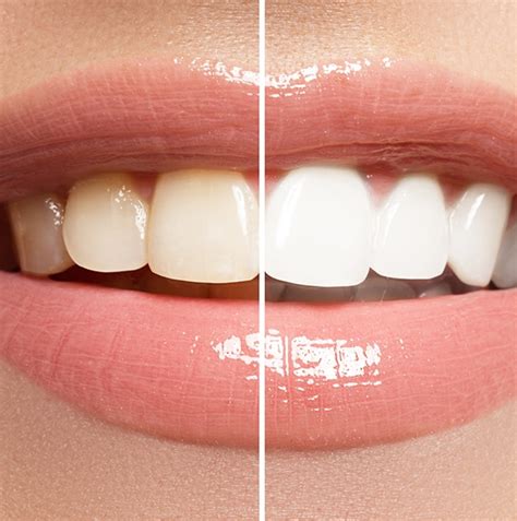 Teeth whitening beaver dam ky  Yellow and brown spots on the tooth are often decalcification stains caused by a buildup of sugar and acids that weaken enamel