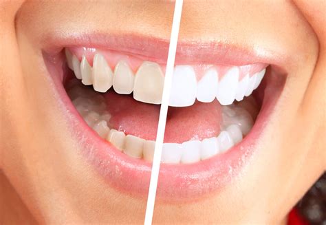 Teeth whitening price cdo  They are made of different ingredients, and in general, their cost can be priced anywhere between $10 and $1000