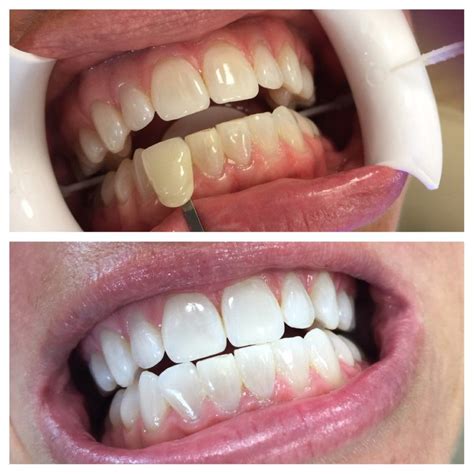 Teeth whitening upper coomera Come in and meet the friendly and professional team at Chempro pharmacy Coomera
