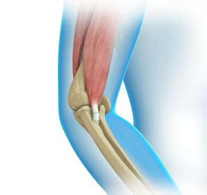 Tendon and ligament repair near graton  If there is severe damage to a lot of the tendon, the surgeon might replace part or all of your Achilles tendon