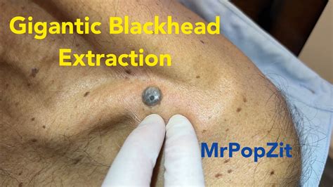 Thigh blackhead extraction  Plus, its zinc content combats sunburn