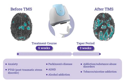 Tms therapy for mdd in bellingham  Food and Drug Administration (FDA) in 2008 for the treatment of major depressive disorder (MDD), though recent research suggests it may be effective for